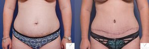tummy tuck surgery - before and after gallery - patient 9A - front view