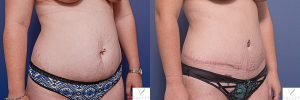 tummy tuck 9B - before and after image - 45 degree view