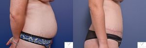 abdominoplasty patient 9C - before and after - side view