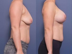 breast lift and implants - before and afters - image 011 - side view
