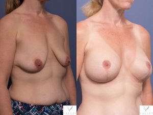 breast augmentation and lift - before and after gallery - image 009 - 45 degree view