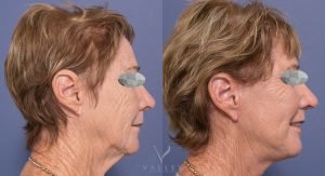 before and after - facelift and neck lift - patient 004 - image 001