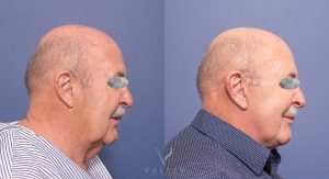 female patient 002 - facelift & neck lift and blilateral blepharoplasties - side view