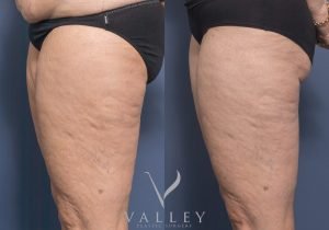 MP Thigh Reduction Side - Thigh Lift Gallery 6