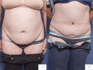 tummy tuck procedure - before and after image gallery - patient 6A