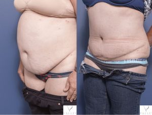 abdominoplasty plastic surgery before and after - patient 6B - 45 degree view