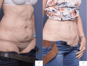 tummy tuck before and after - patient 7B - 45 degree view
