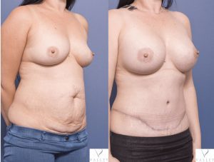 mummy makeover before & after gallery 008 - breast implants and abdominoplasty - 45 degree view