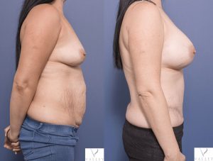before and after - mummy makeover 007 - breast augmentation and tummy tuck