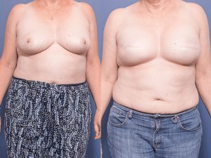 before and after breast lift - patient 006A - front view