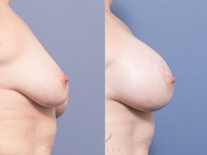 CJ Breast Augmentation Side 1 - Breast Augmentation Gallery 15