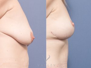 CJ Breast Reduction side 1 - Breast Reduction Gallery 6