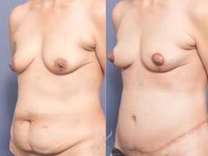 MP Belt Lipectomy and Bilateral Breast Mastopexy Oblique - Breast Lift Brisbane 11