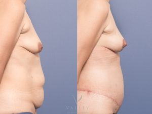 MP Belt Lipectomy and Bilateral Breast Mastopexy Side - Breast Lift Brisbane 12