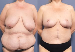 MP front breast reduction and belt lipectomy - Belt Lipectomy Gallery 1