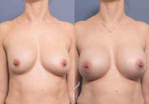 MP front remove and replace implants - Breast Augmentation Brisbane 13