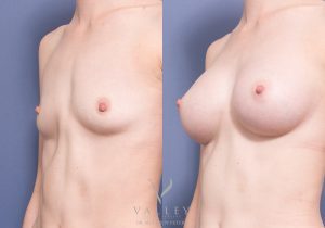 MP oblique bilateral breast augmentation - Breast Augmentation Brisbane 8