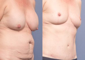 MP oblique breast explant mastopexy abdominoplasty - Breast Lift Brisbane 2