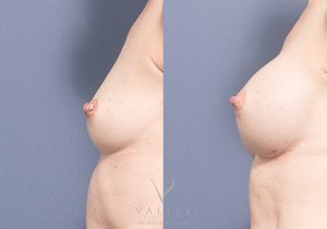 MP side breast augmentation - Breast Augmentation Brisbane 3