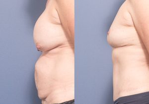 MP side breast explant mastopexy abdominoplasty - Breast Lift Gallery 3