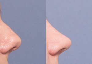 RG septorhinoplasty side - Rhinoplasty/Nose Job Brisbane 4