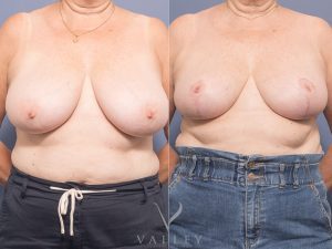 AS BBR Front 1 - Breast Reduction Gallery 17