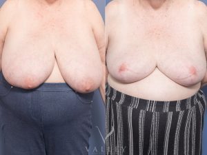 AS BBR Front 4 - Breast Reduction Gallery 14