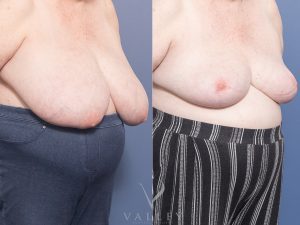 AS BBR Oblique 3 - Breast Reduction Gallery 15