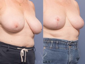 AS BBR Oblique - Breast Reduction Gallery 18