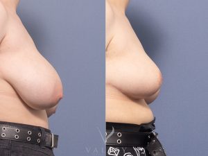 AS BBR side - Breast Reduction Gallery 3